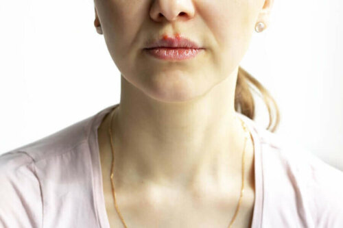 kadın dudak pemfigus vulgaris