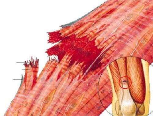 Bir kas yırtılması.