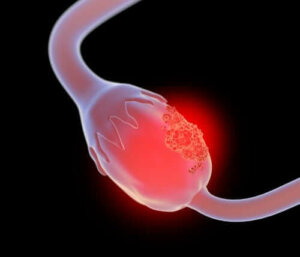 Yumurtalıkta Görülen Dev Müsinöz Kistadenom Nedir?