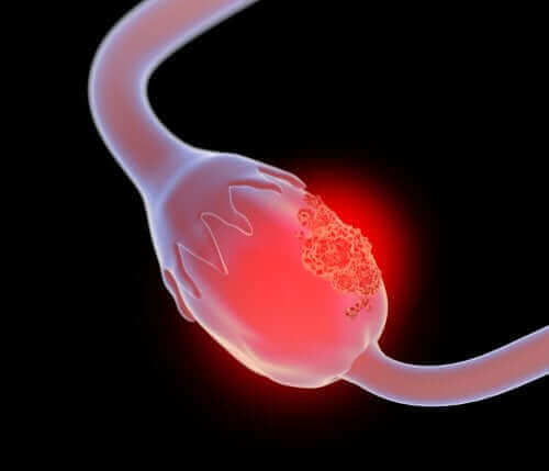 Yumurtalıkta Görülen Dev Müsinöz Kistadenom Nedir?