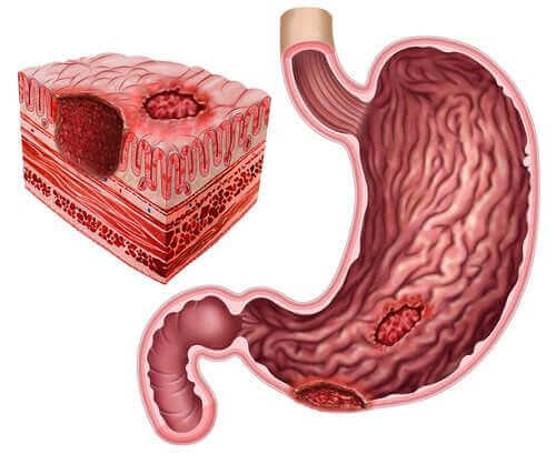 Peptik Ülser ve Helicobacter Pylori