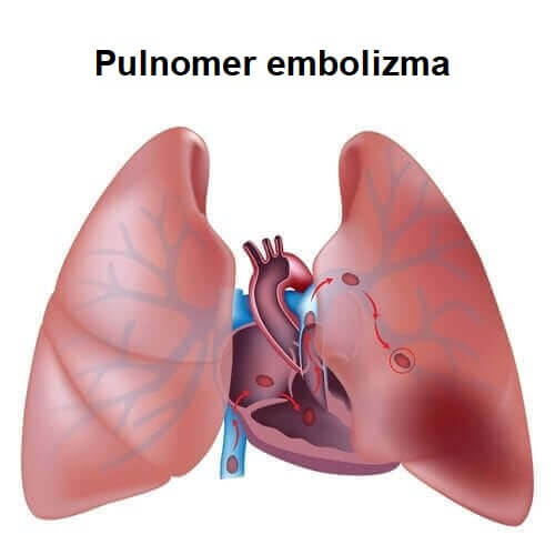 Pulmoner Tromboembolizm Hakkında Bilmeniz Gereken Her Şey