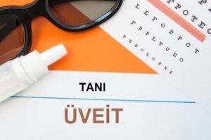 Üveit Semptomları Nelerdir?