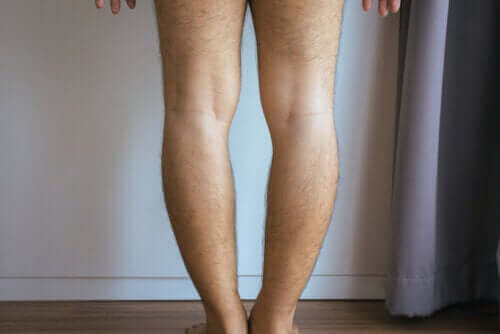 Çarpık Bacak veya Parantez Bacak: Nedenleri ve Tedavisi