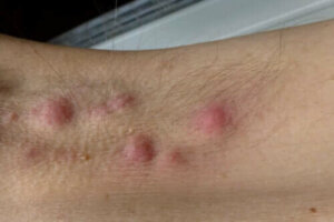 Diyet Hidradenitis Supurativa Tedavisinde Etkili midir?