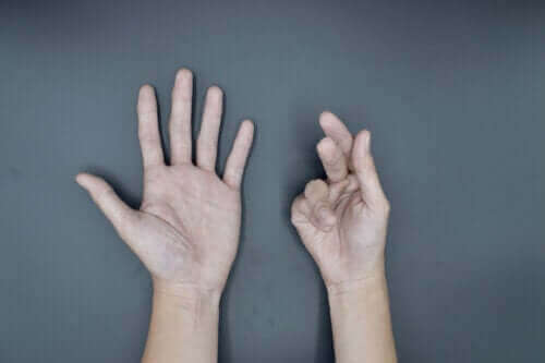 Dupuytren Kontraktürünün Nedenleri ve Tedavileri