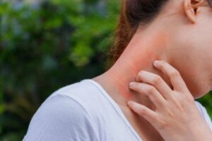 Dermatit ve Kortikosteroidler Arasındaki Bağlantı