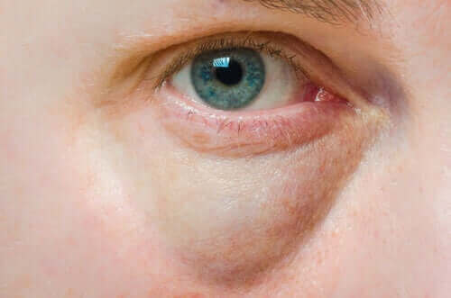 Şişmiş Göz Kapaklarının Nedenleri ve Tedavileri