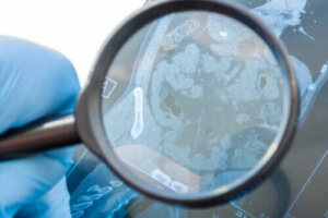 Gastrointestinal Fistül Nedir ve Neden Olur?