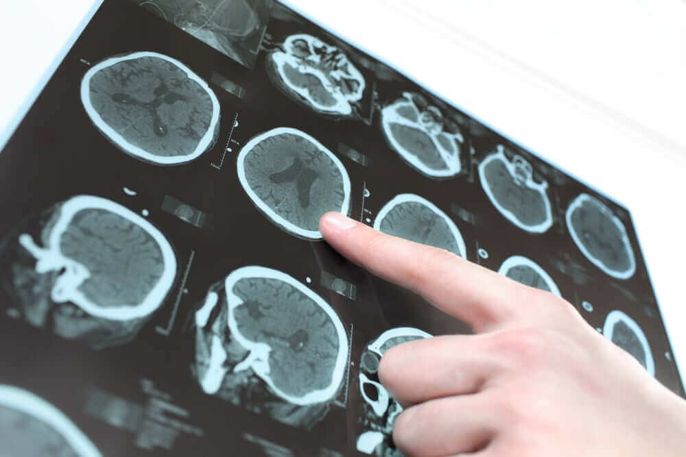 beyin tomografisi