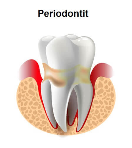 Periodontitli diş