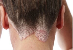 Saçkıranı Tedavi Etmek İçin En İyi Çözümler