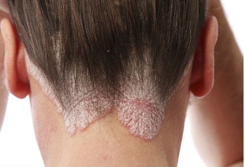 Saçkıranı Tedavi Etmek İçin En İyi Çözümler