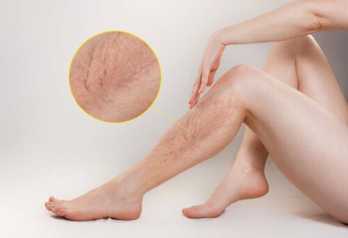 Varisli Damarlar İçin En İyi 10 Çözüm