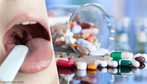 Akut Tonsillit Tedavisi