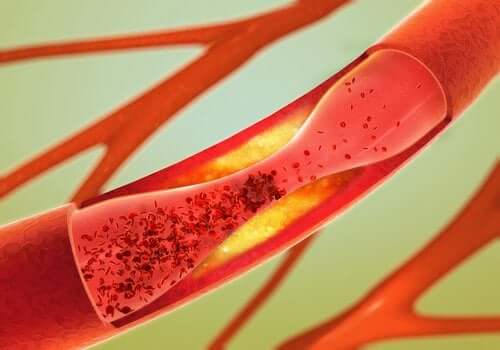 Arterioskleroz Nedir?