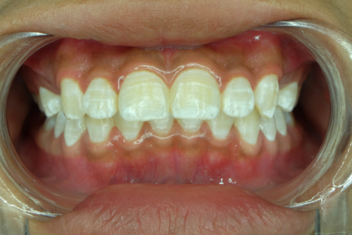 Dişlerdeki Beyaz Noktalar: Neden Ortaya Çıkarlar?